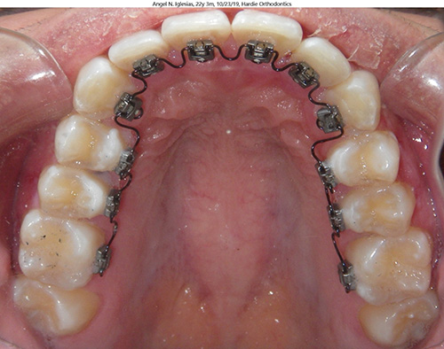 Lingual Braces - West Side Orthodontics
